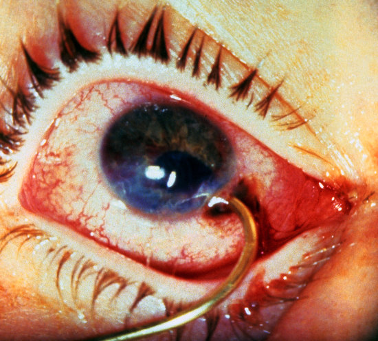 Eye protection – Hook, line & sinker